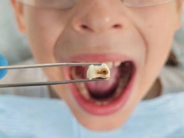 Best Broken or Cracked Tooth Emergency Dentist in Hillsdale, MI